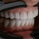 Transformez votre sourire avec les facettes dentaires : un guide complet