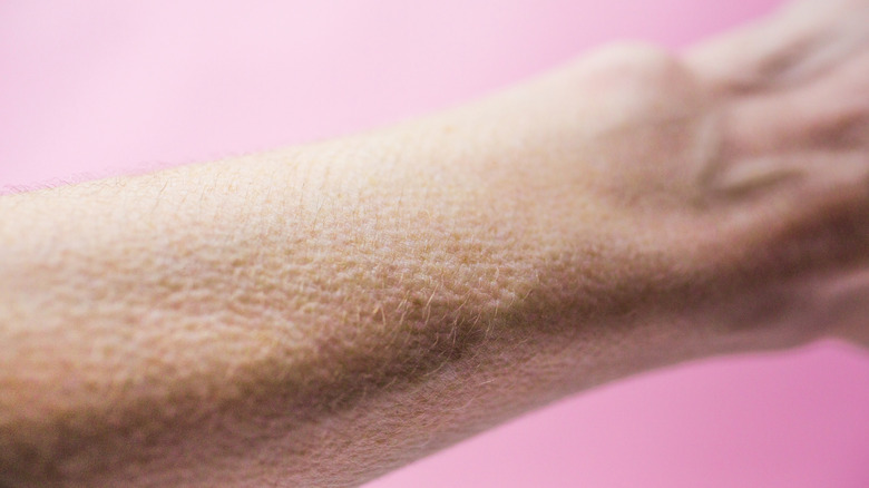 Chair de poule sur le bras d'une personne