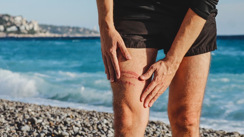 Un homme se tient sur une plage avec une piqûre de méduse sur la jambe