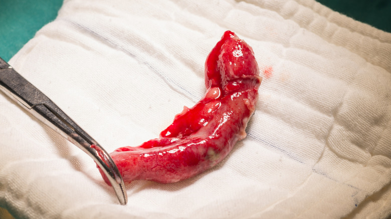 Gros plan d'un annexe enflammé avec un outil chirurgical sur une serviette après le retrait