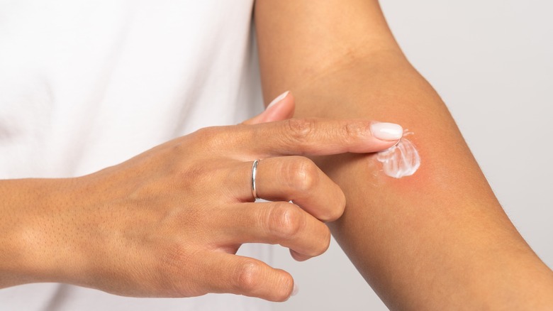 Personne mettant de la crème sur une démangeaison