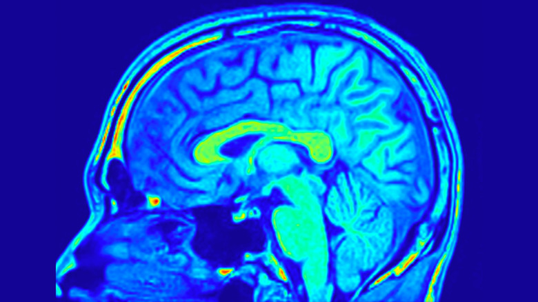 IRM du cerveau humain