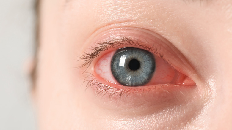 Oeil irritée roux
