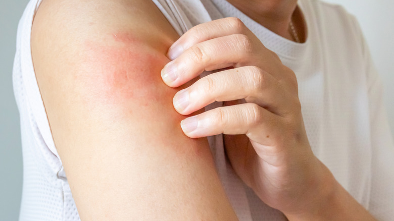 Une personne se gratte le bras qui est rouge et irrité.