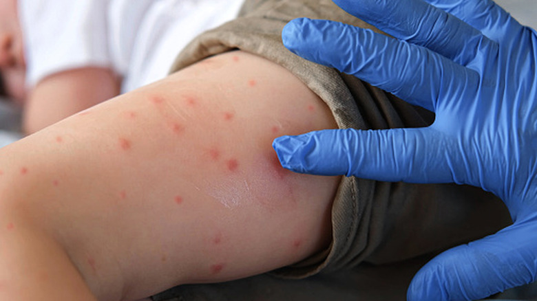 La main dans un gant bleu sonde un bras avec une éruption cutanée rouge, des bosses rouges