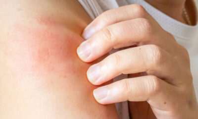 La raison pour laquelle nos démangeaisons cutanées sont plus graves que vous ne le pensez