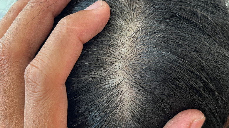 Gros plan du cuir chevelu humain avec des follicules pileux montrant