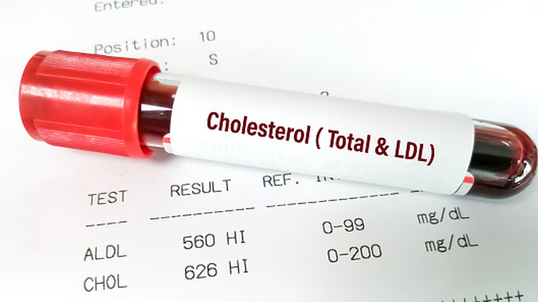 Échantillon de sang sur papier avec résultats de laboratoire
