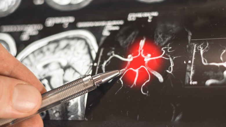 Gros plan d'un scanner cérébral, médecin pointant vers une activité avec un stylo métallique