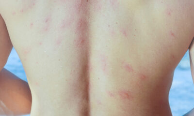 Que faire si vous attrapez le pou du poisson sur la plage