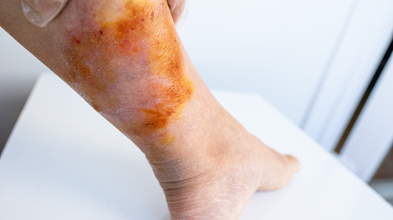 Plusieurs piqûres de méduses sur la jambe d'une personne