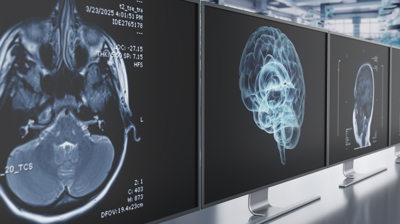 Scanners cérébraux haute résolution montrant l'anatomie détaillée du cerveau