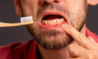 Des choses grossières qui arrivent lorsque vous arrêtez de vous brosser les dents pendant une semaine