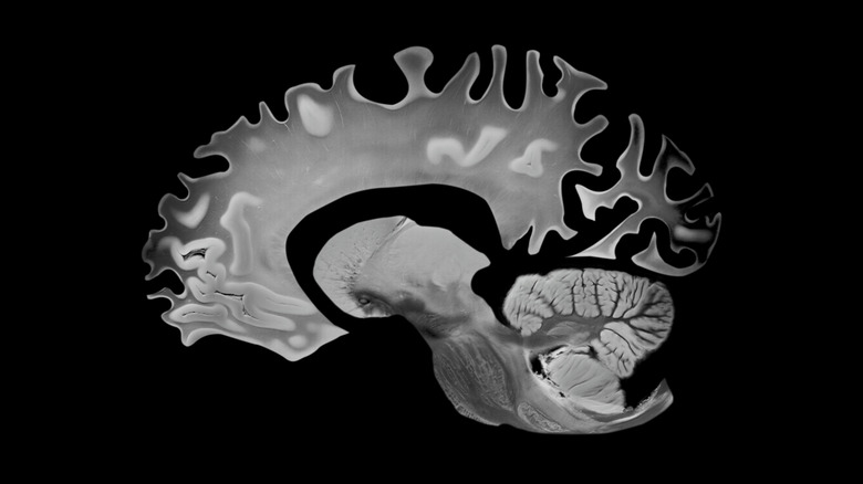 dommages au cerveau causés par la maladie d'Alzheimer