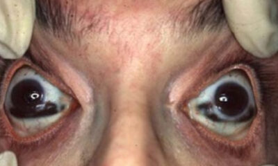 Le phénomène bizarre qui arrive aux yeux humains après la mort