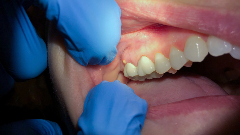 Dentiste examinant un abcès près des molaires d'une personne