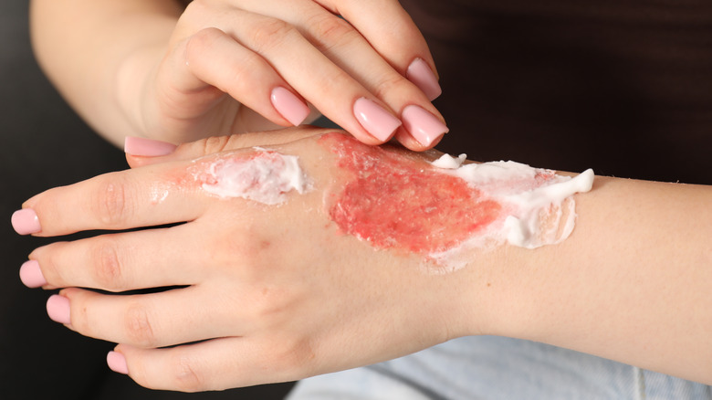 Femme répandant de la crème sur une brûlure