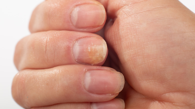 Gros plan sur les ongles jaunis