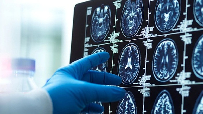 Un médecin montrant des images de scanners cérébraux