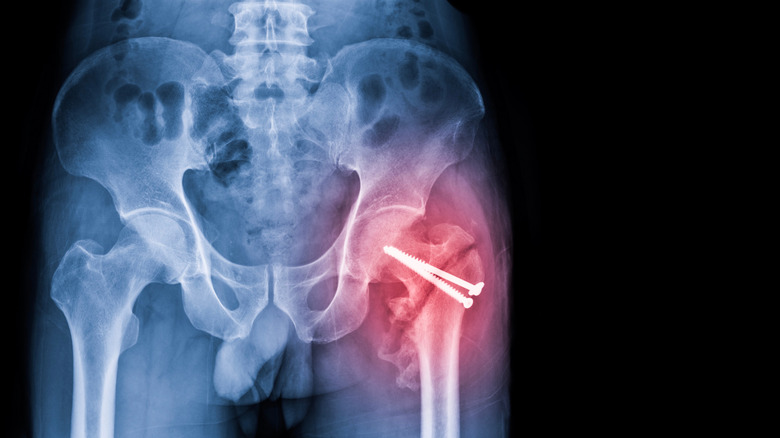 Image radiographique d'une fracture de la hanche due à l'ostéoporose