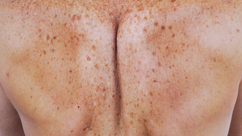 Image du dos d'une personne présentant une hyperpigmentation