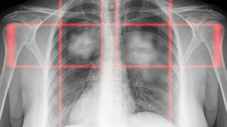 Image radiographique montrant un cancer du poumon