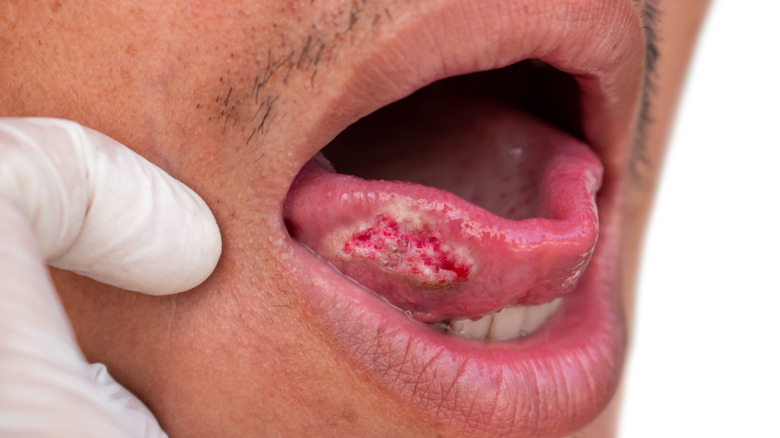 Carcinome épidermoïde de la langue