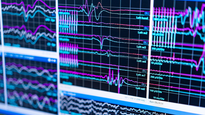 Modèles d'ondes cérébrales d'un EEG sur un écran d'ordinateur