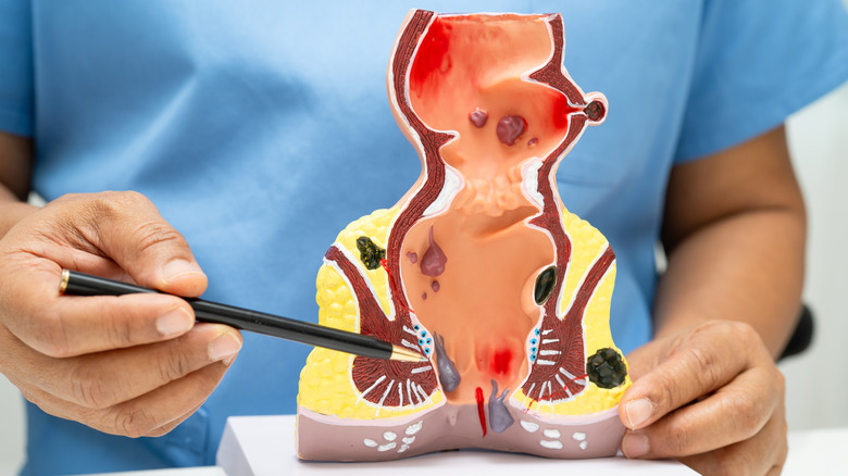 Médecin utilisant un stylo pour pointer vers un modèle anatomique du rectum et du canal menant à l'anus