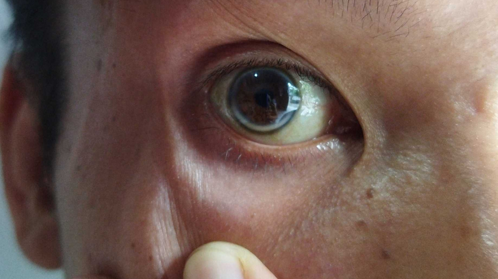 Si vous avez moins de 50 ans, un anneau gris autour de votre cornée pourrait signaler des problèmes de santé