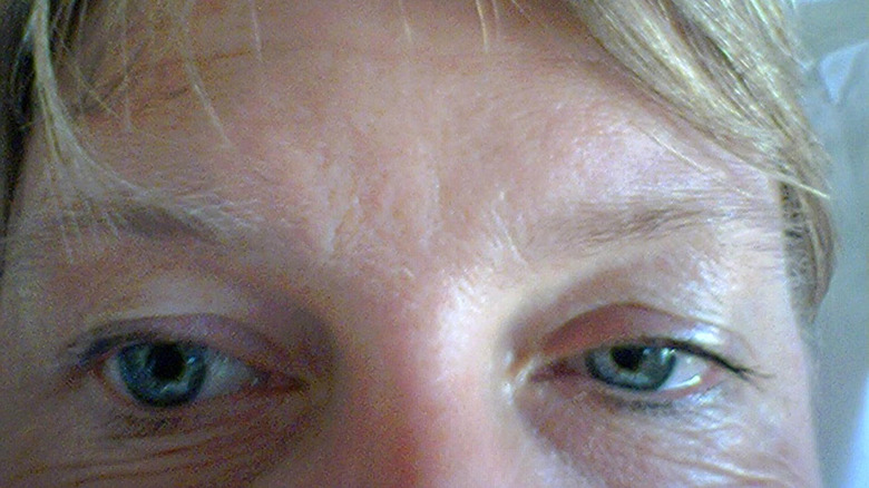 gros plan des yeux avec un côté montrant l'affaissement caractéristique et la pupille rétrécie