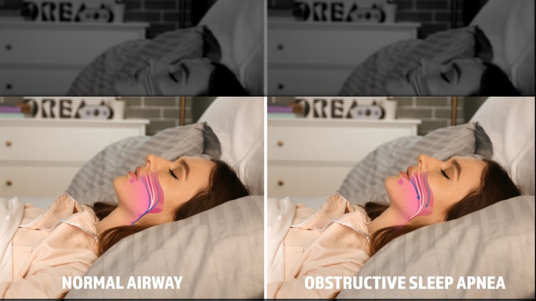 Images d'une jeune femme endormie, montrant la différence entre le ronflement normal et l'apnée du sommeil