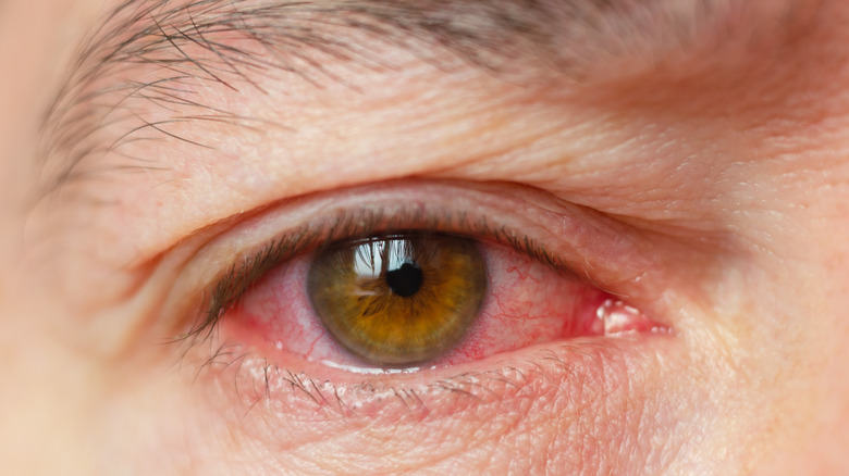 Gros plan d'un oeil masculin humain avec un oeil rose, rouge et enflammé