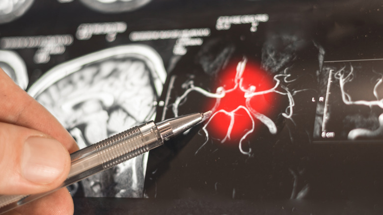 Un médecin montrant un scanner cérébral