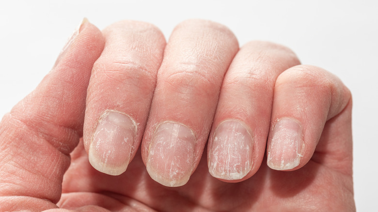 Main avec des ongles cassants et qui pèlent