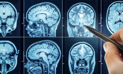 Les scientifiques ont fait allonger 13 hommes la tête baissée pendant 60 jours. Voici ce que leur cerveau a révélé