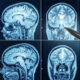 Les scientifiques ont fait allonger 13 hommes la tête baissée pendant 60 jours. Voici ce que leur cerveau a révélé