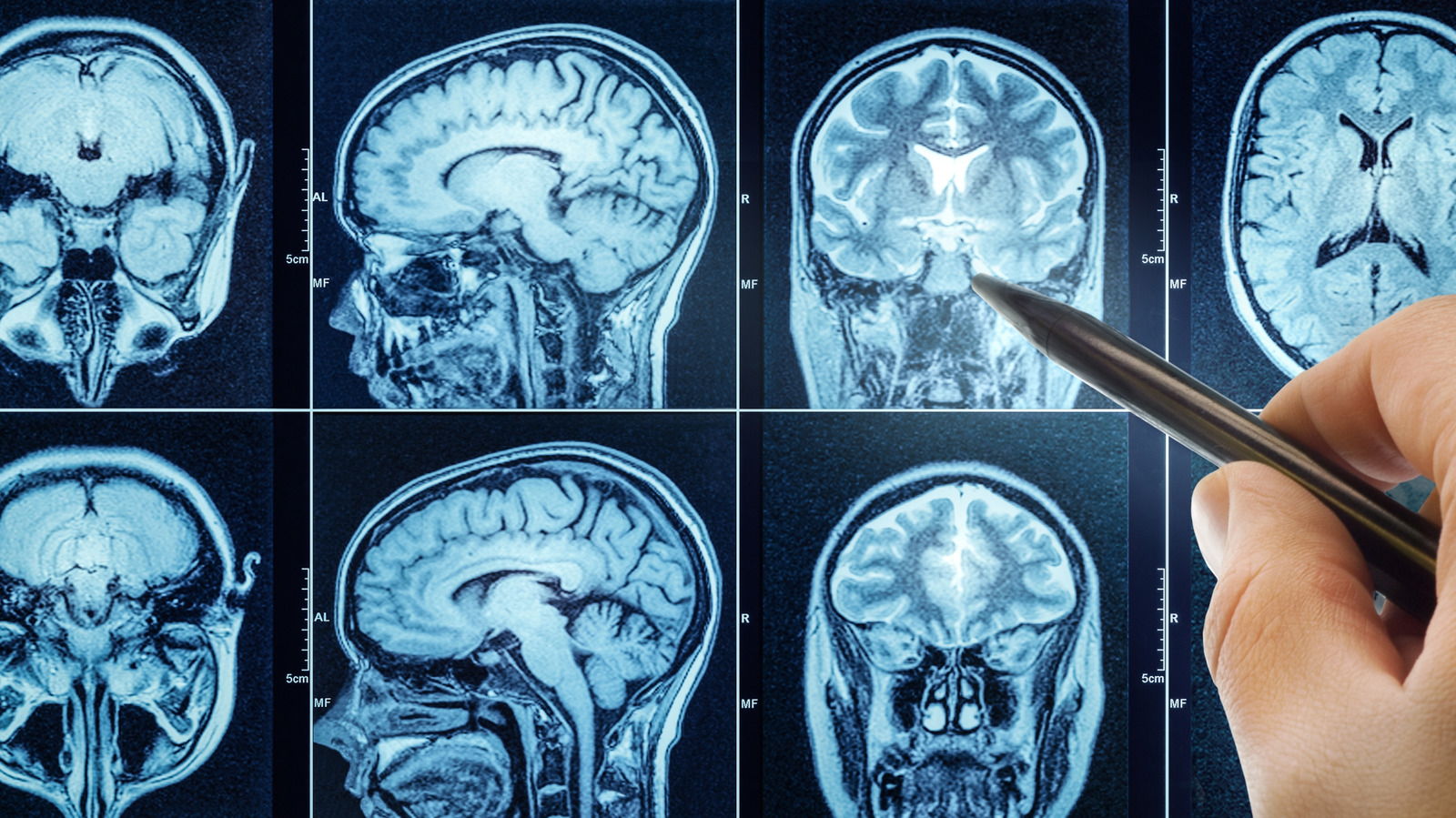 Les scientifiques ont fait allonger 13 hommes la tête baissée pendant 60 jours. Voici ce que leur cerveau a révélé